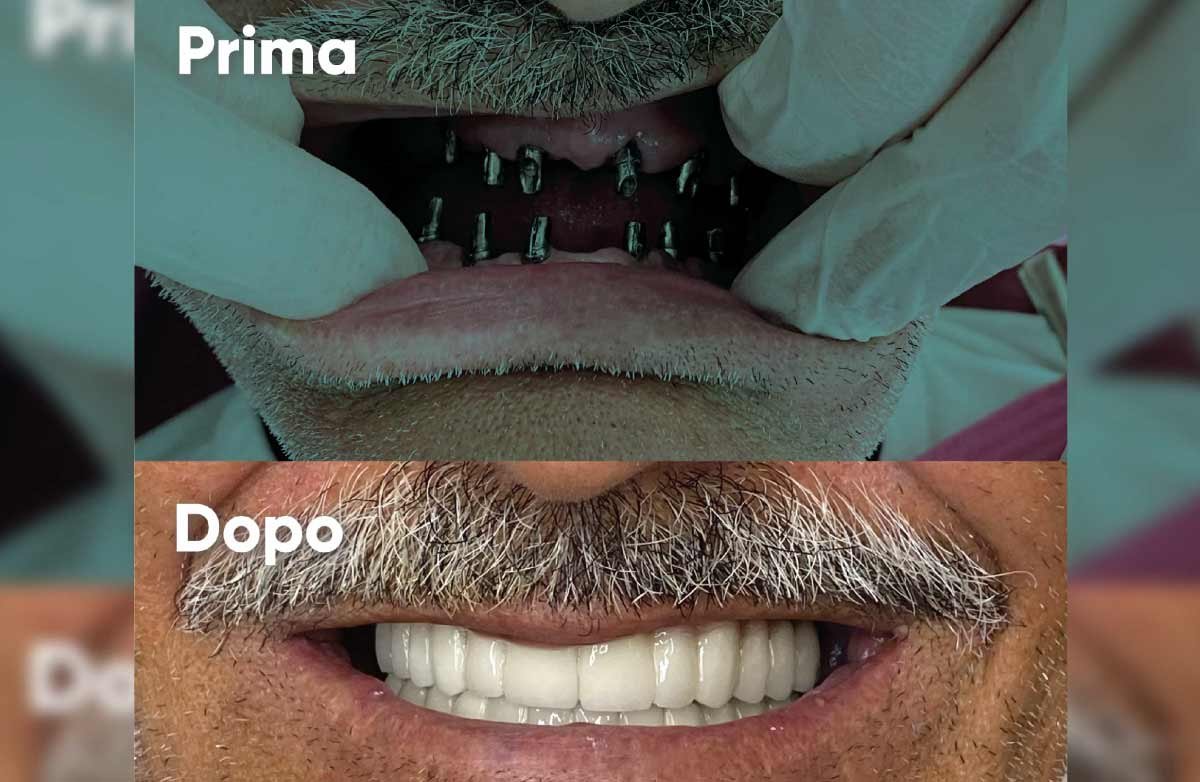 Prima e Dopo 1