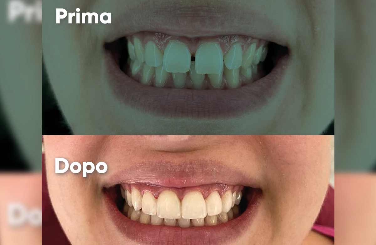 Prima e Dopo 2